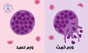 الخطيب اصيب به ننشر الفرق بين الورم الحميد والخبيث والخطورة الخفية 2 الورم الحميد