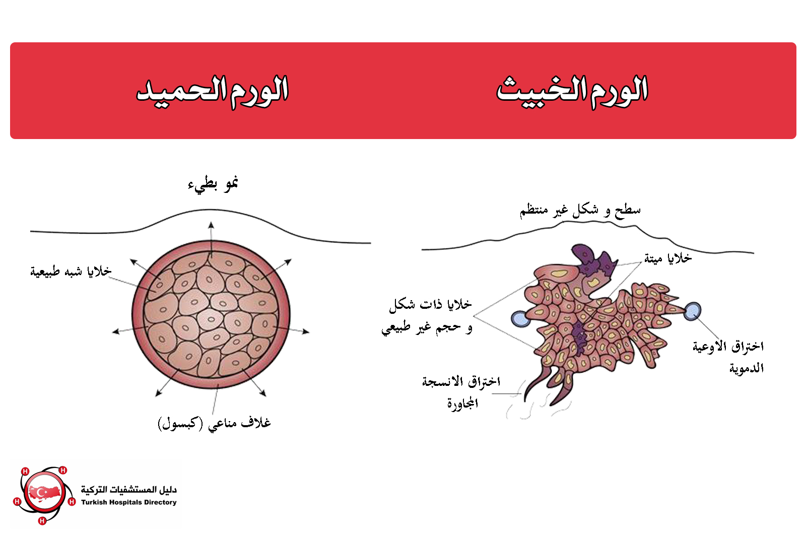 الخطيب اصيب به ننشر الفرق بين الورم الحميد والخبيث والخطورة الخفية 3 متى تتحول الأورام الحميدة إلى خبيثة