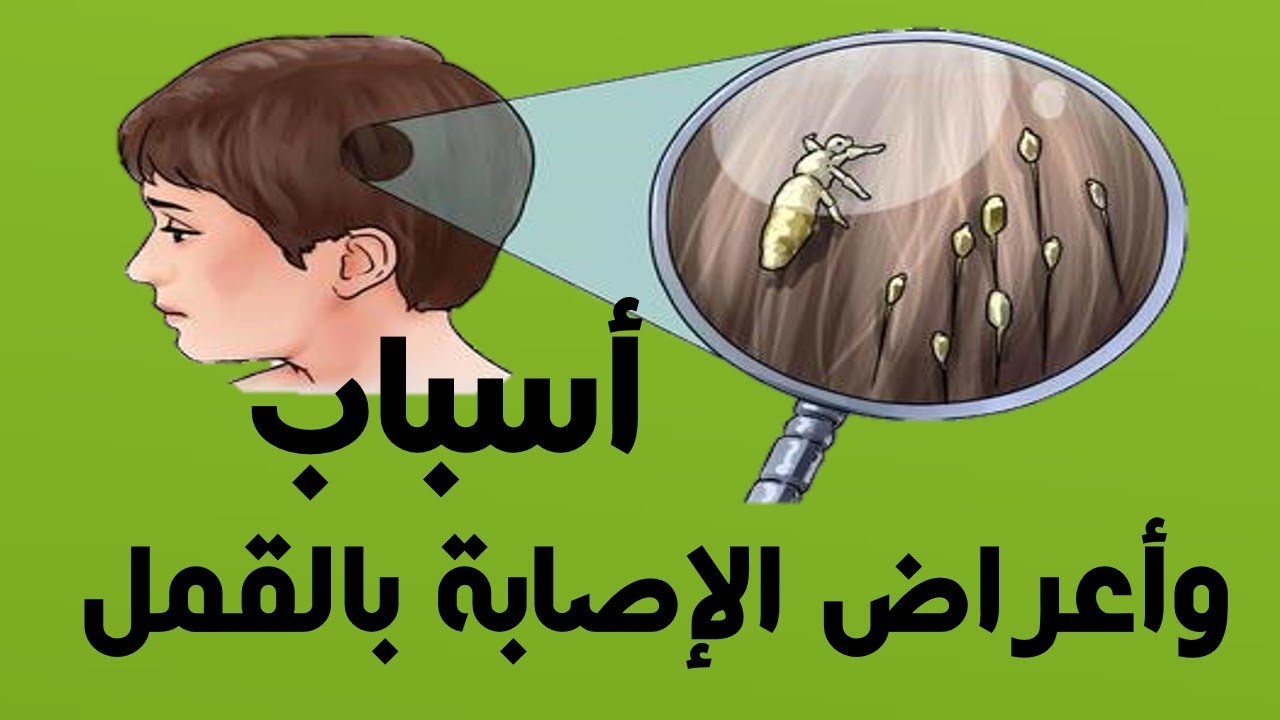 طريقة علاج قمل الرأس عند الأطفال مشكلة شائعة فى المدارس 3 علاج قمل الرأس عند الأطفال