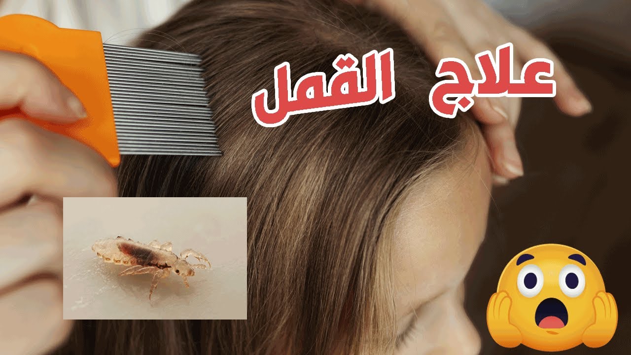 طريقة علاج قمل الرأس عند الأطفال مشكلة شائعة فى المدارس 4 علاج قمل الرأس عند الأطفال