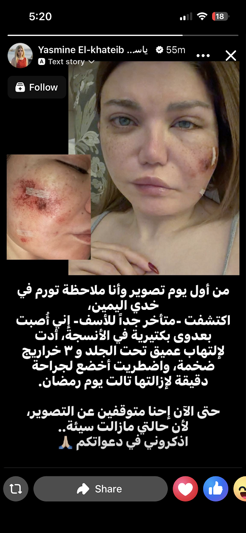 معلومات عن المرض الذي أصاب ياسمين الخطيب إليك تفاصيل توضيح الأطباء 3 اصابة ياسمين الخطيب بعدوى بكتيرية