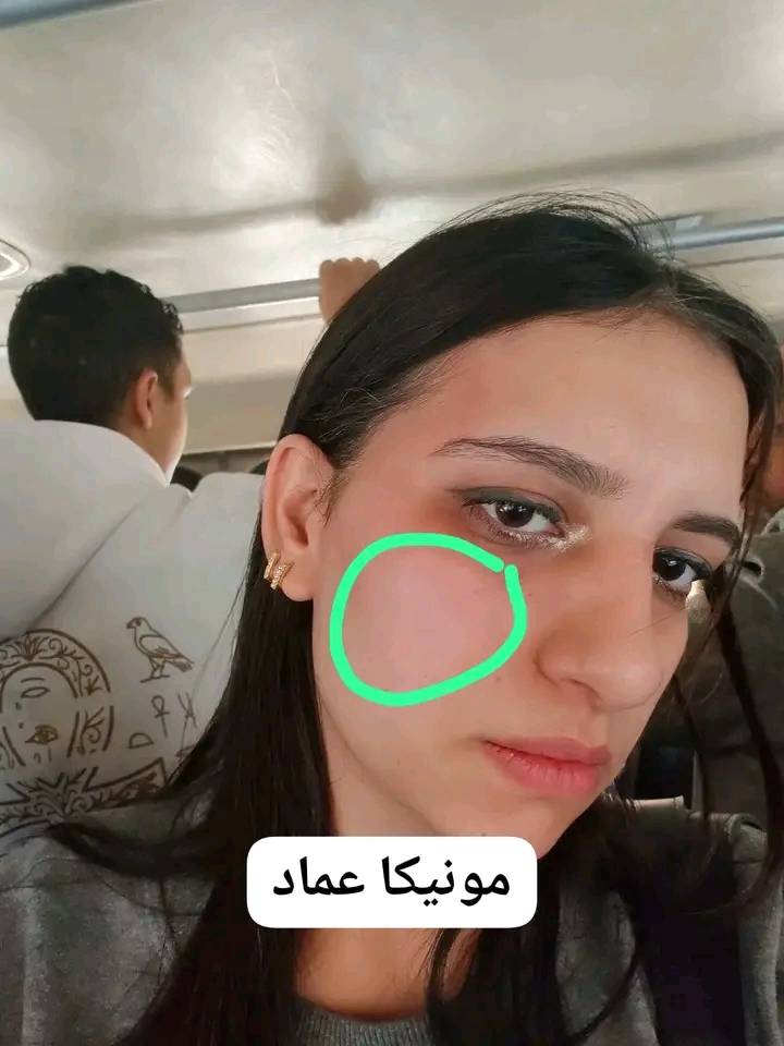مونيكا عماد ضحية الفيديو المتداول بسبب مقعد شخص اعتدى علي بالسب والصفع داخل أتوبيس بالخصوص 2 مونيكا عماد ضحية ضربها داخل اتوبيس