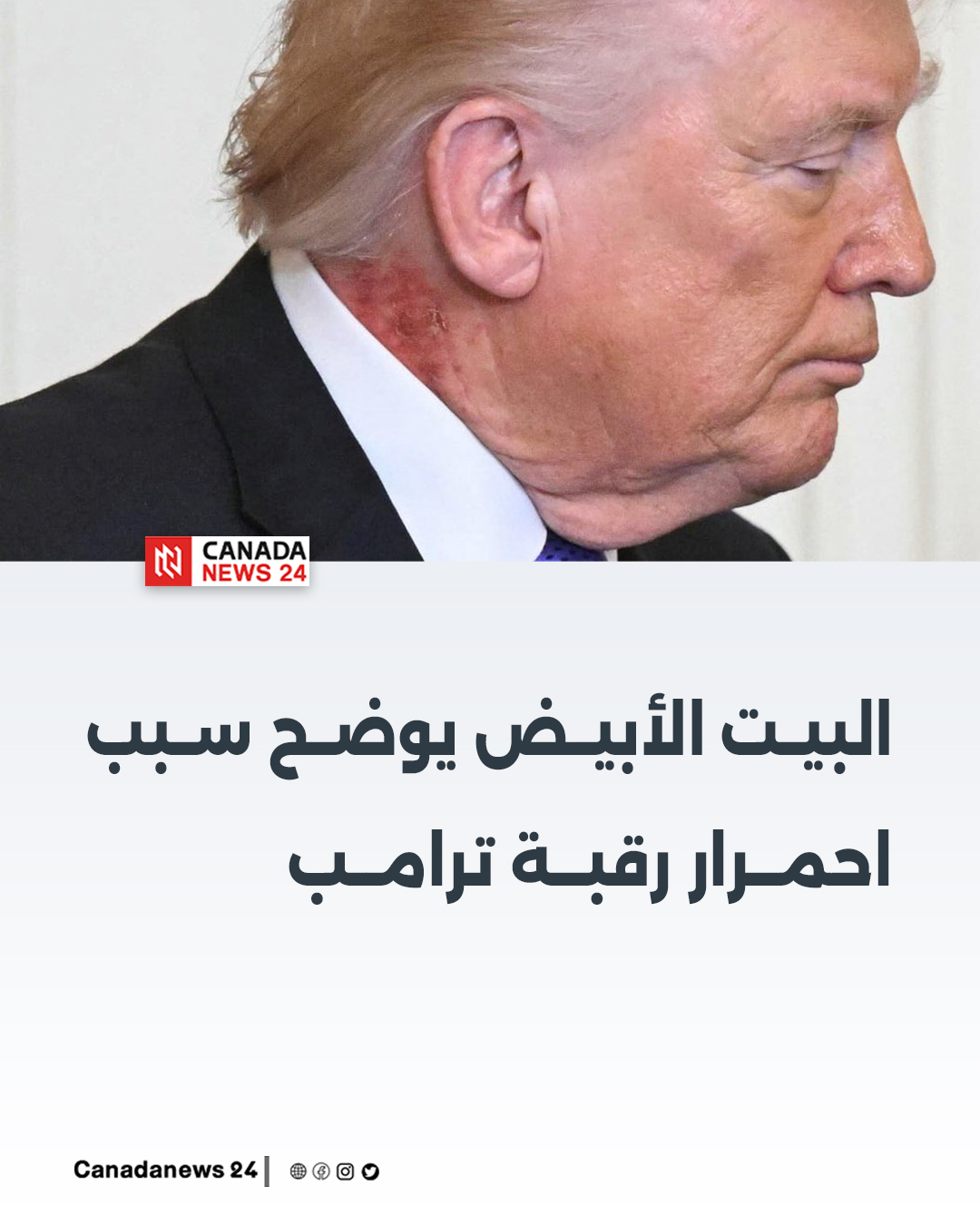 حقيقة احمرار رقبة دونالد ترامب البيت الأبيض يوضح التفاصيل 2 احمرار رقبة دونالد ترامب