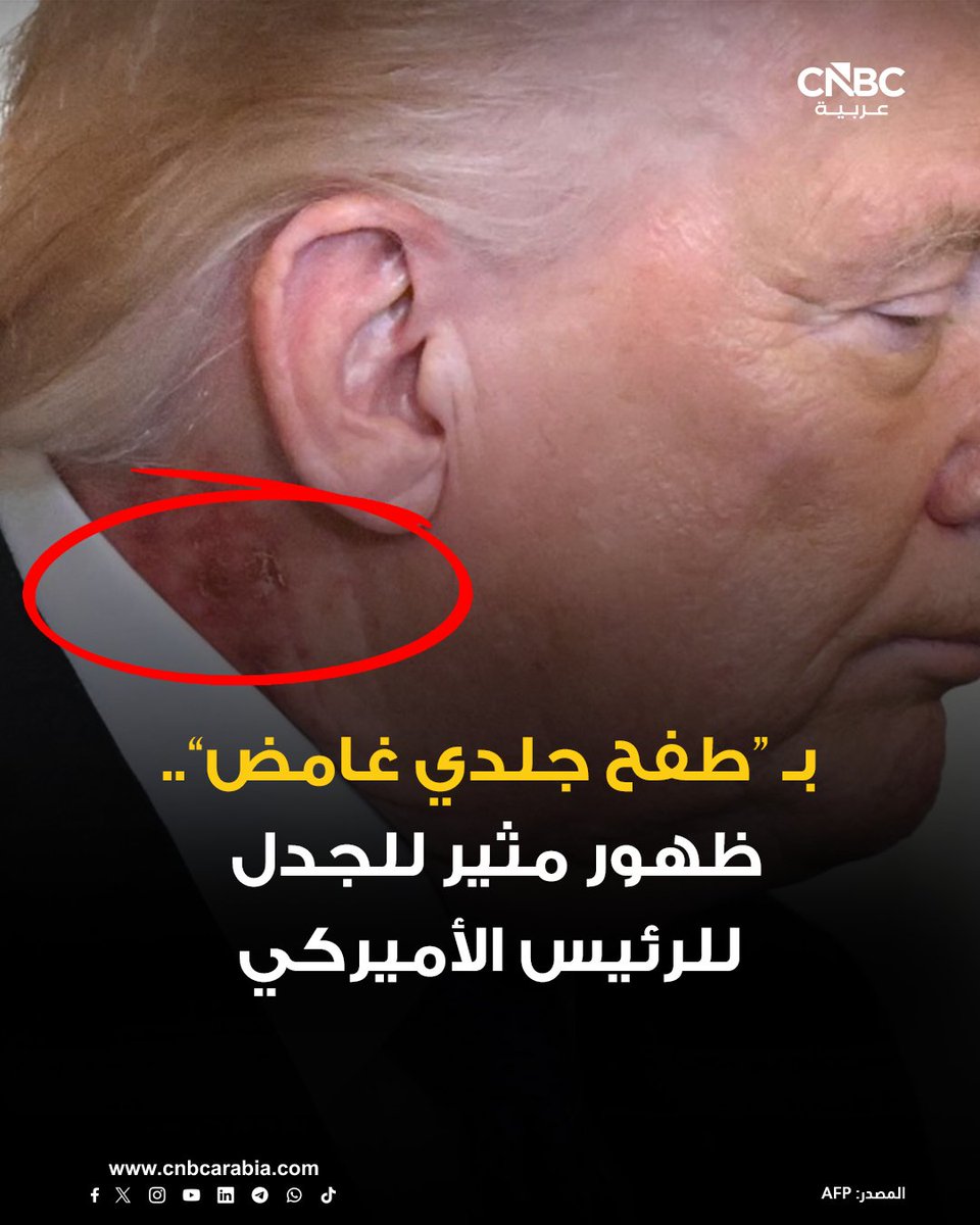 حقيقة احمرار رقبة دونالد ترامب البيت الأبيض يوضح التفاصيل 3 احمرار رقبة دونالد ترامب