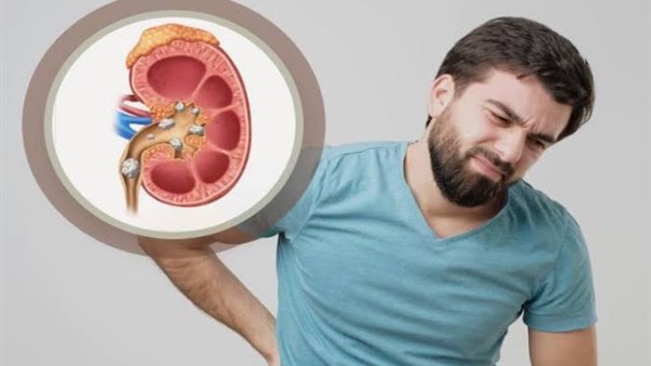 مشروبات معروفة تؤدي لحصوات الكلى احذروها 2 مشروبات تؤدي إلى تكون حصوات الكلى