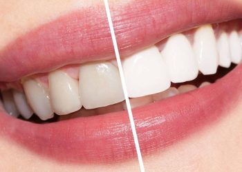أسنان ناصعة دون طبيب 3 طرق منزلية سهلة لعلاج اصفرار الأسنان 12 تنبييض الأسنان