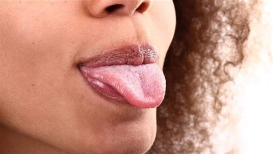احذر قبل فوات الأوان علامات في اللسان تدل على الإصابة بأمراض خطيرة 2 T News P 399048 636719256680831951