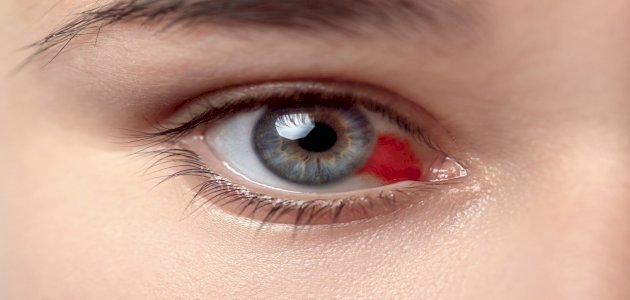 أسباب ظهور بقعة دم في بياض العين