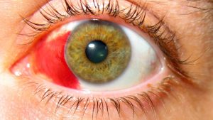 تمزق الأوعية الدموية في العين