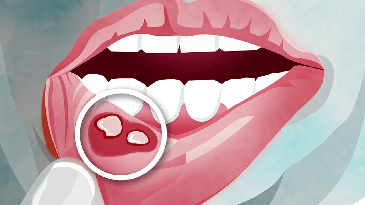 منزليًا إليك طرق علاج تقرحات الفم بسهولة 6 علاج تقرحات الفم