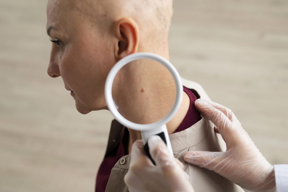 الأكتشاف المبكر لـ سرطان الجلد