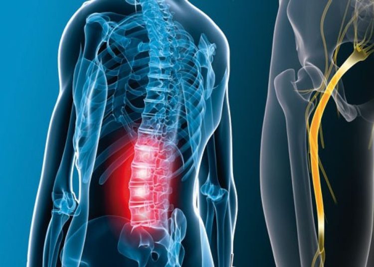 تمارين لعلاج عرق النسا في البيت ما تدورش كتير 1 الخيار لعلاج اتمارين لعلاج عرق النسا لالتهاب العظمي