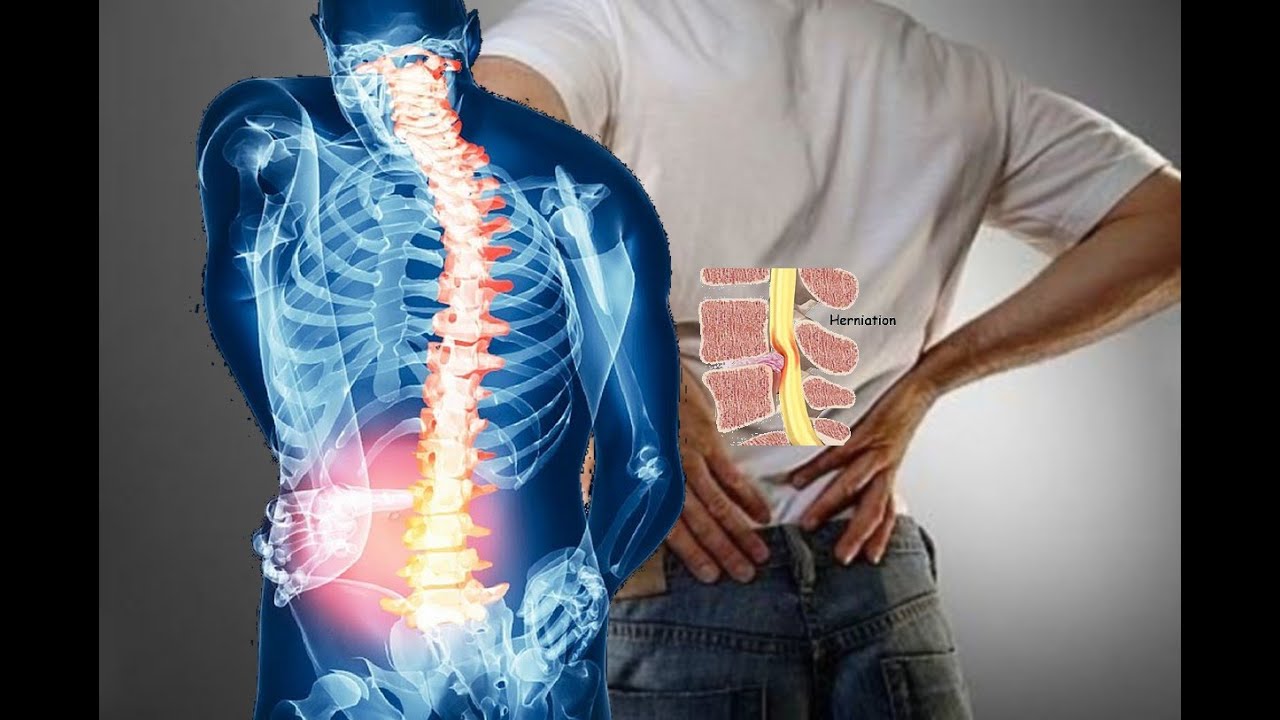 من هم الأكثر عرضة لهشاشة العظام تعرف عليهم 3 الخيار لعلاج الالتهاب العظمي