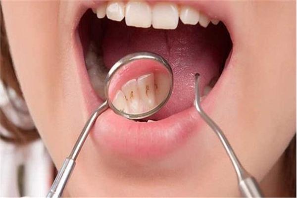 من البيت خلطات لإزالة تراكم الجير من أسنانك 3 خلطات لإزالة تراكم الجير من أسنانك