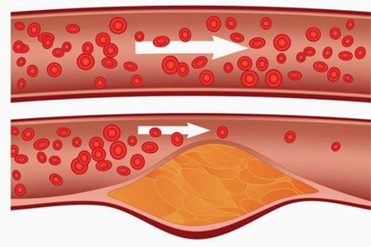علامات ارتفاع مستوى الكوليسترول في الدم