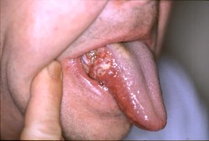 سرطان- الفم- احذر -هذه- الأعراض