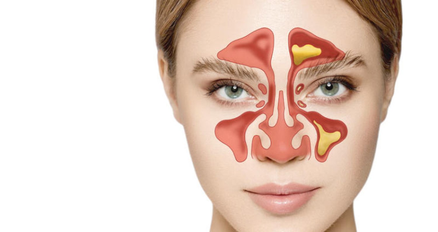 مش محتاج دكتور لمرضى الجيوب الأنفية علاجات طبيعية من المنزل 4 elgyob el anfya la