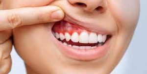عدم تنظيف الأسنان يسبب مرض جسيم 