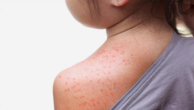 5 نصائح لحماية أطفالك من حمو النيل في موجة الحر 1 نصائح لحماية أطفالك من حمو النيل