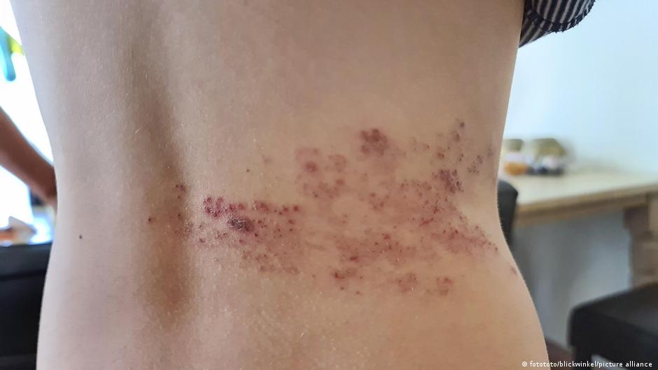 تدل على السرطان لو ظهرت علامات في مناطق معينة بالجسم 5 علامات تدل على السرطان