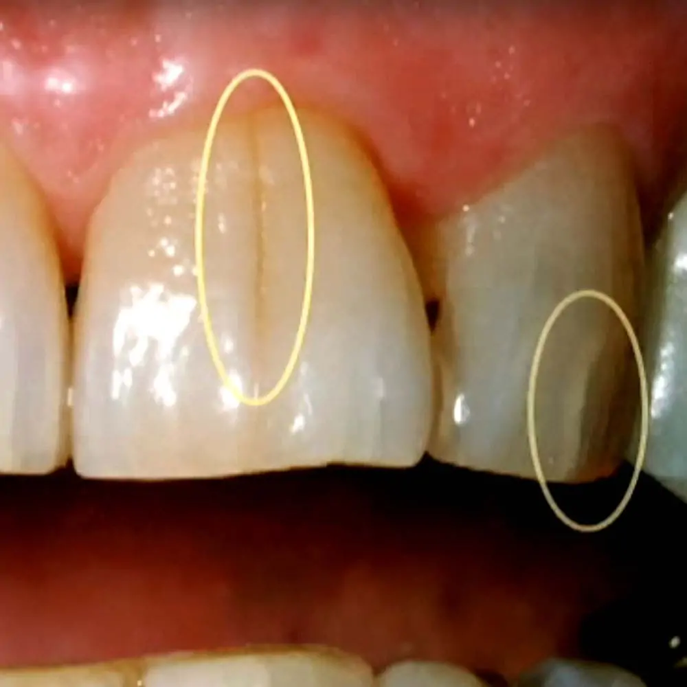 علاج متلازمة الأسنان المتشققة