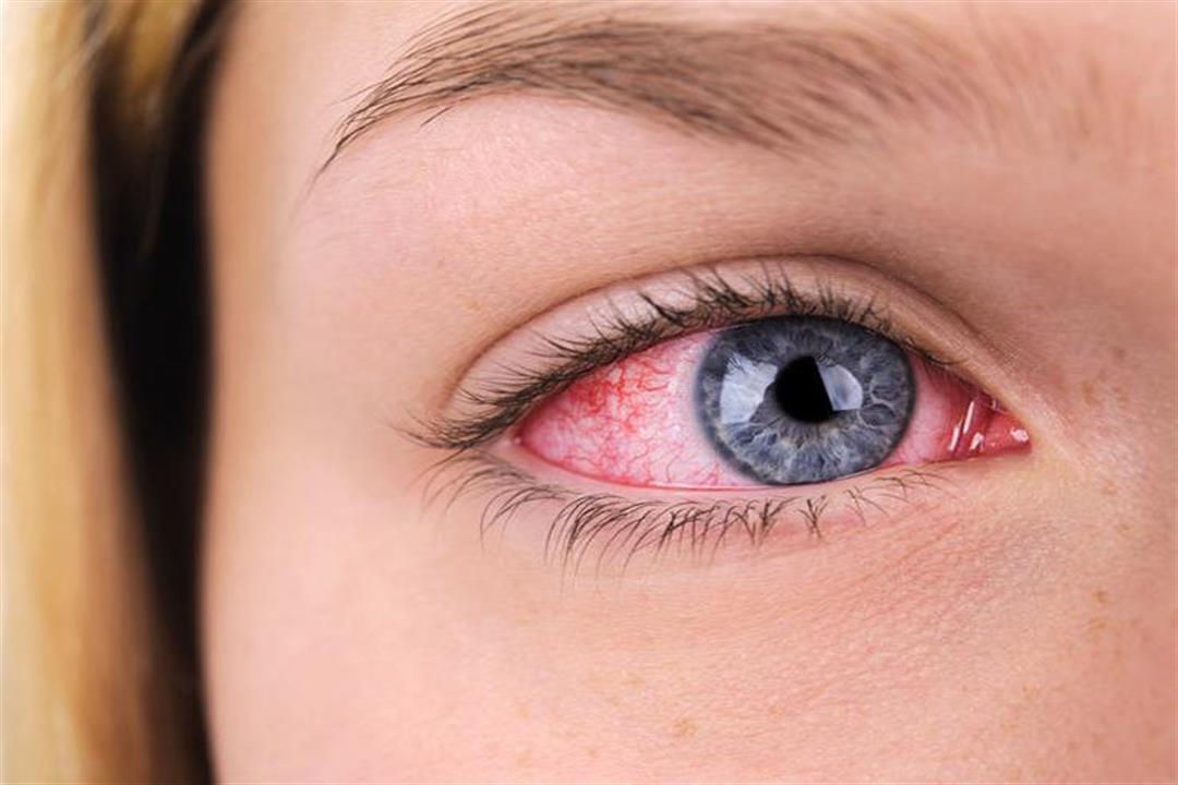 نصائح لعلاج جفاف العين
