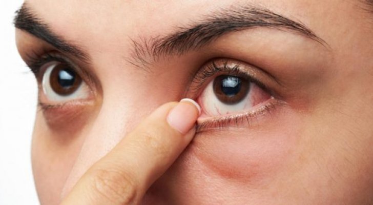 نصائح لعلاج جفاف العين 