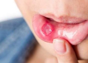تجربة علاج قرح الفم في المنزل