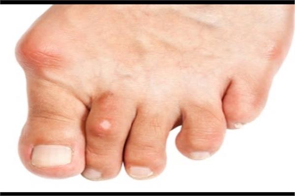 لو عايز علاج عين السمكة والكالو هاني الناظر يقدم روشتة فعالة 5 علاج عين السمكة والكالو