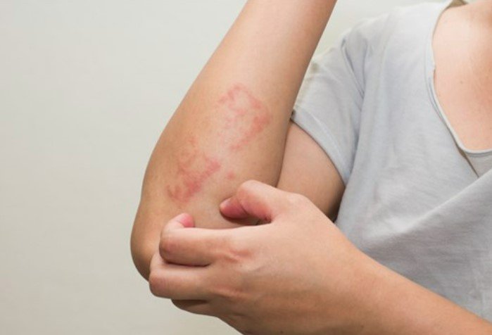 حيل منزلية وأدوية علاج السعفة تصيب من الجسم أجزاء كثيرة 3 أهم طرق علاج السعفة
