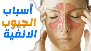 ما هو التهاب الجيوب الأنفية الحاد أسبابه وأعراضه 3 التهاب الجيوب الأنفية الحاد