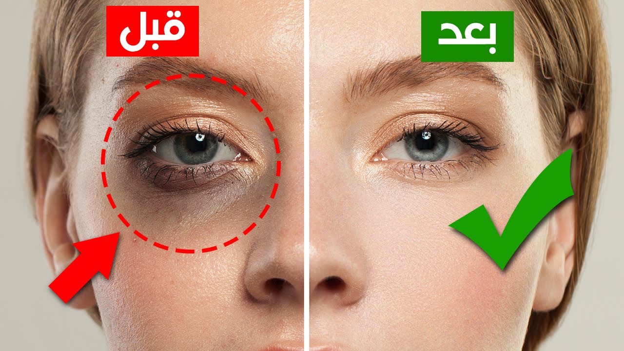 تخلصي من الهالات السوداء بالجزر والعسل من منزلك 3 hallat
