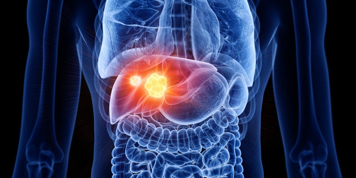 الفرق بين أعراض سرطان الكبد وعسر الهضم