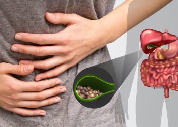 حصوات المرارة تنبيه لهؤلاء الأكثر عرضة للإصابة