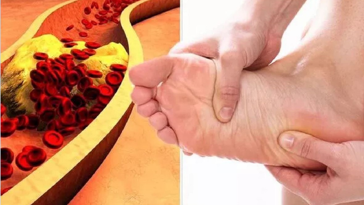 احذر ارتفاع الكولسترول في هذه الحالة يتحول إلى مرض مميت 2 احذر ارتفاع الكولسترول