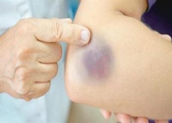 اعرف الأسباب مؤشر على جلطات الدم لو بتظهر فى جسمك كدمات مفاجئة