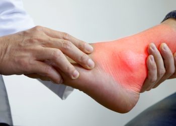 تعرف على المشاكل الصحية التي يسببها النقرس غير ألام المفاصل 4 المشاكل الصحية التي يسببها النقرس
