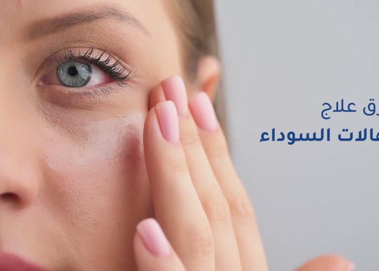 وداعًا للكونسيلر طريقة غسول طبيعي للتخلص من الهالات السوداء نهائيًا 1 غسول طبيعي للتخلص من الهالات