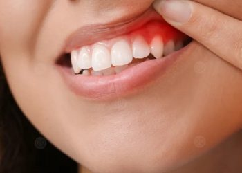 علاج التهابات اللثة 5 وصفات طبيعية أغربها الشاي