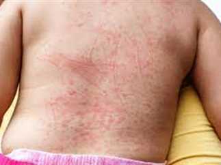 تحذيرات عاجلة من منظمة الصحة العالمية من أنتشار حمى الضنك 2 أنتشار حمى الضنك