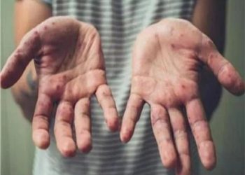 عدوى جديري مائي بين الطلاب