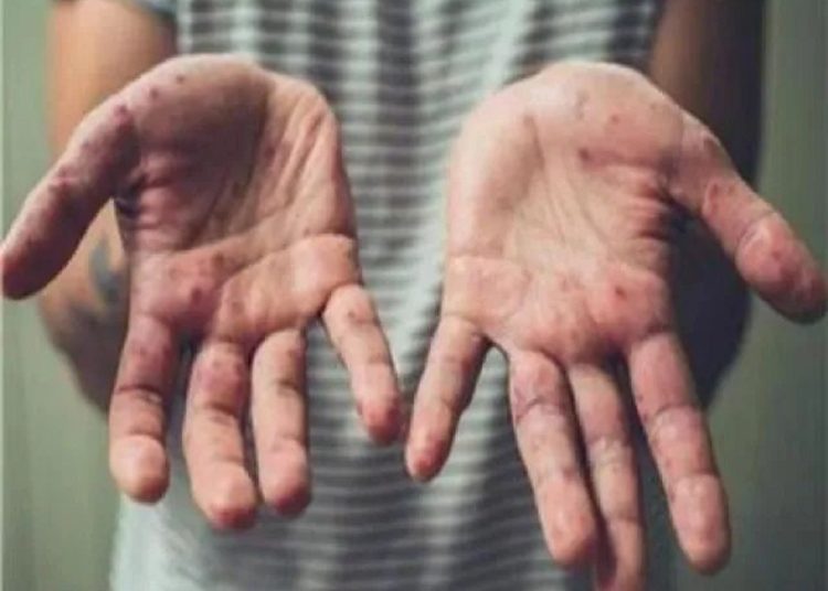 انباء عن ظهور حالات جديري مائي بإحدى المدارس و حالة من القلق وتأجيل امتحانات الطلاب المصابين 1 عدوى جديري مائي بين الطلاب