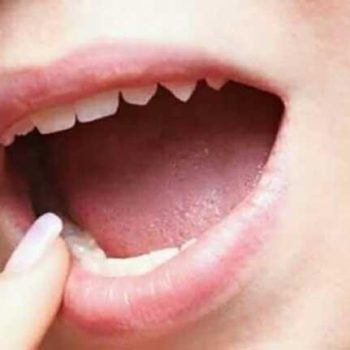 علاج بطرق بسيطة عند حرق اللسان بعد تناول مشروب ساخن 2 علاج حرق اللسان