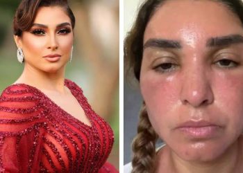 أضرار الجلوس في الشمس لفترات طويلة عقب حرق وجه الفنانة روجينا