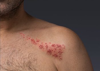 إهمال علاج مرض الحزام الناري