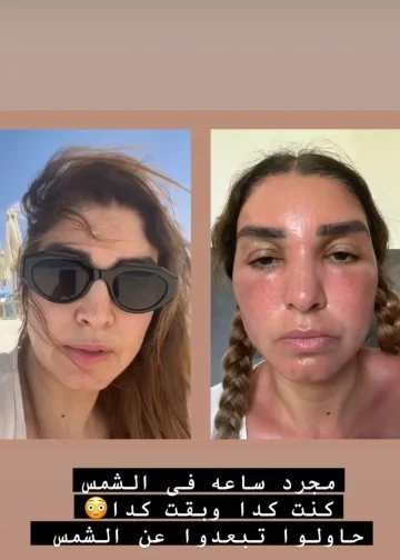 أضرار الجلوس في الشمس لفترات طويلة عقب حرق وجه الفنانة روجينا 2 أضرار الجلوس في الشمس