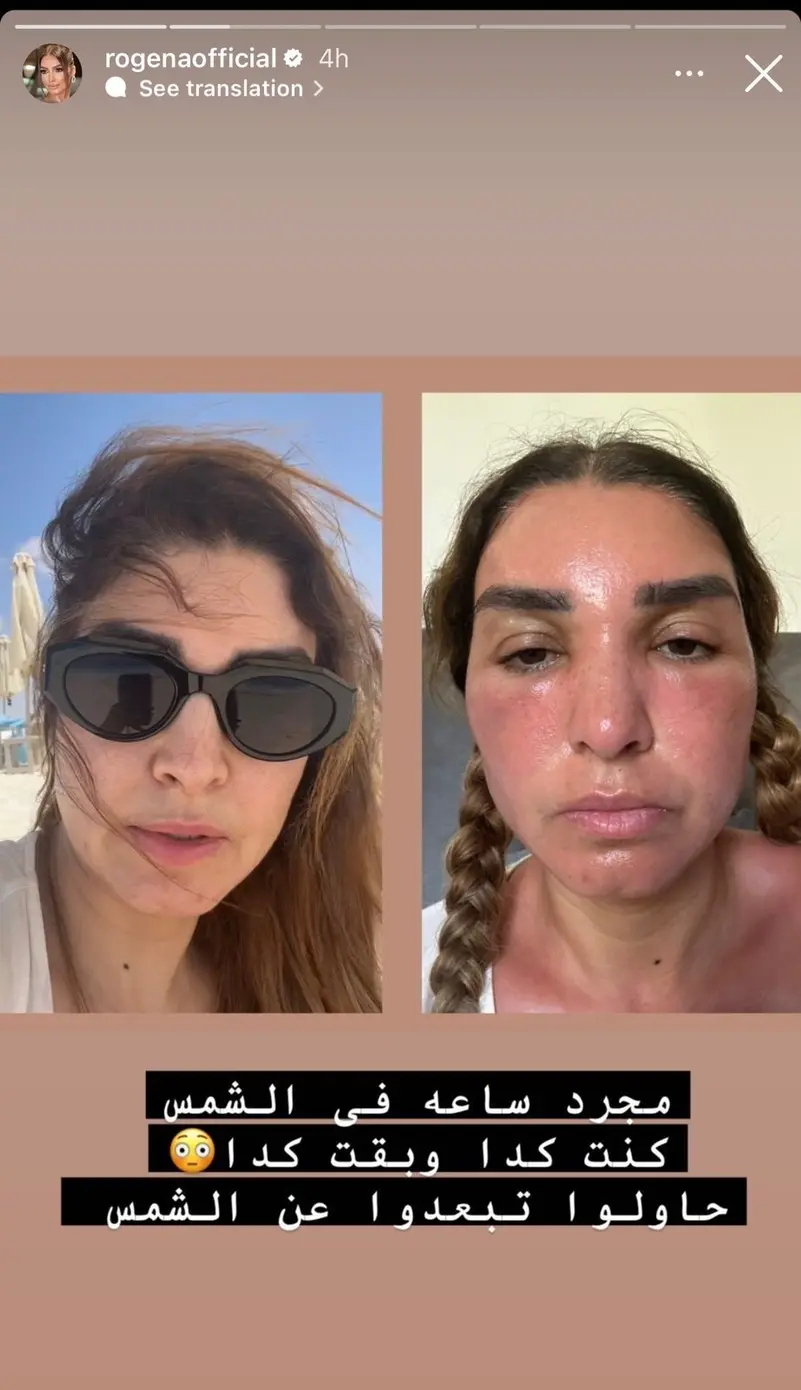 حروق وتضخم بالوجه روجينا تكشف تفاصيل ما حدث لوجهها 3 روجينا تكشف تفاصيل ما حدث لوجهها
