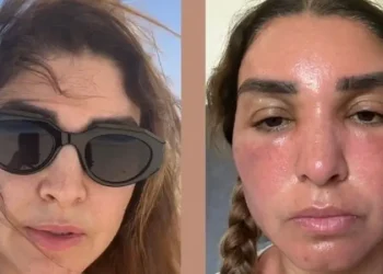 أضرار الجلوس في الشمس