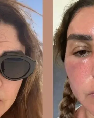 أضرار الجلوس في الشمس لفترات طويلة عقب حرق وجه الفنانة روجينا 3 أضرار الجلوس في الشمس