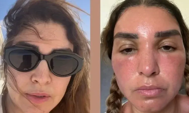 حروق وتضخم بالوجه روجينا تكشف تفاصيل ما حدث لوجهها 1 أضرار الجلوس في الشمس